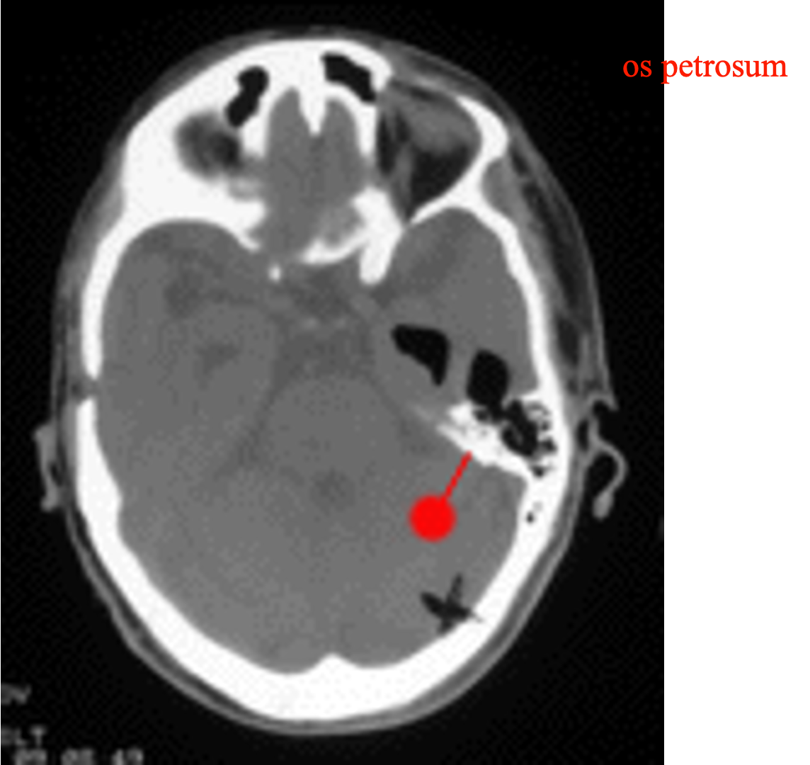 <p>What is a potential cause of spontaneous pneumocephalus in the absence of trauma?</p>