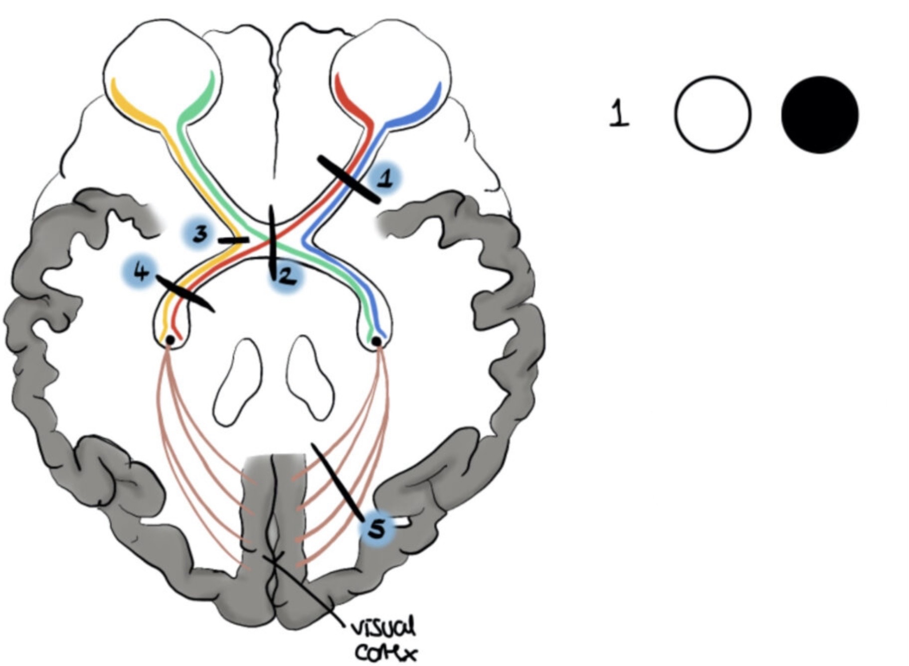 <p>What visual field defect is shown</p>