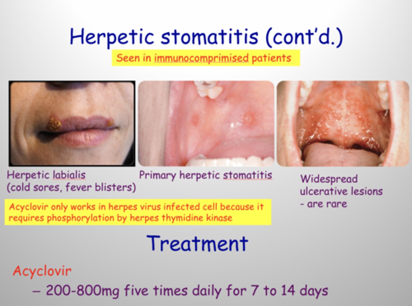 <p>herpetic stomatitis</p><p>tx: acyclovir, liquid diet and numbing medication , lidocaine rinse if pain severe</p>