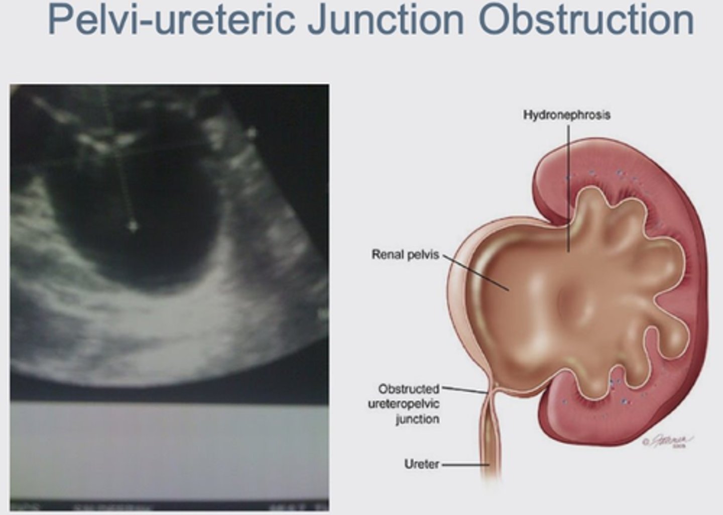 <p>Niercysten zijn in se een ruimte-innemend proces en kunnen abdominaal drukgevoel en klinisch palpeerbaar zijn. In sommige gevallen geven ze druk op het pyelocalciële stelsel geven en zo obstructie veroorzaken waardoor ... ontstaat.</p>