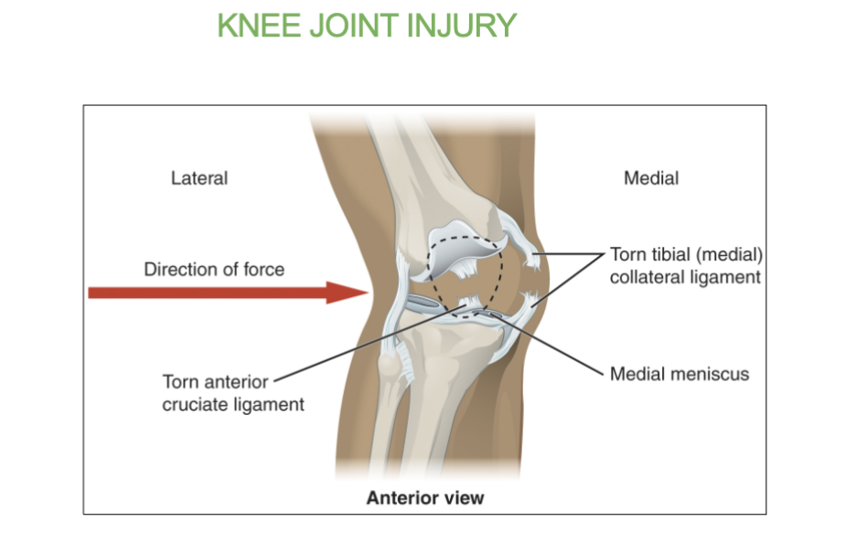 <p>the AnterioR cruciate ligament ( ACL )</p>
