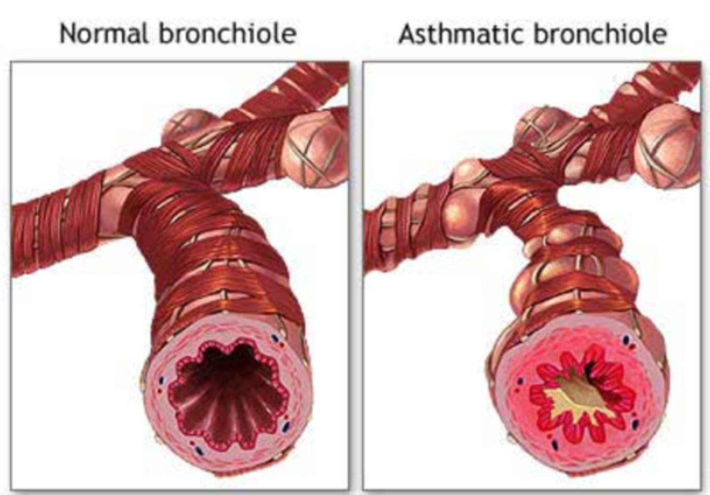 <p>In asthmatic patients, the smooth muscle layer in the bronchioles (and other airways) is much larger than in patients without asthma, so the lumen (where the air flows) is smaller causing airflow obstruction.</p>