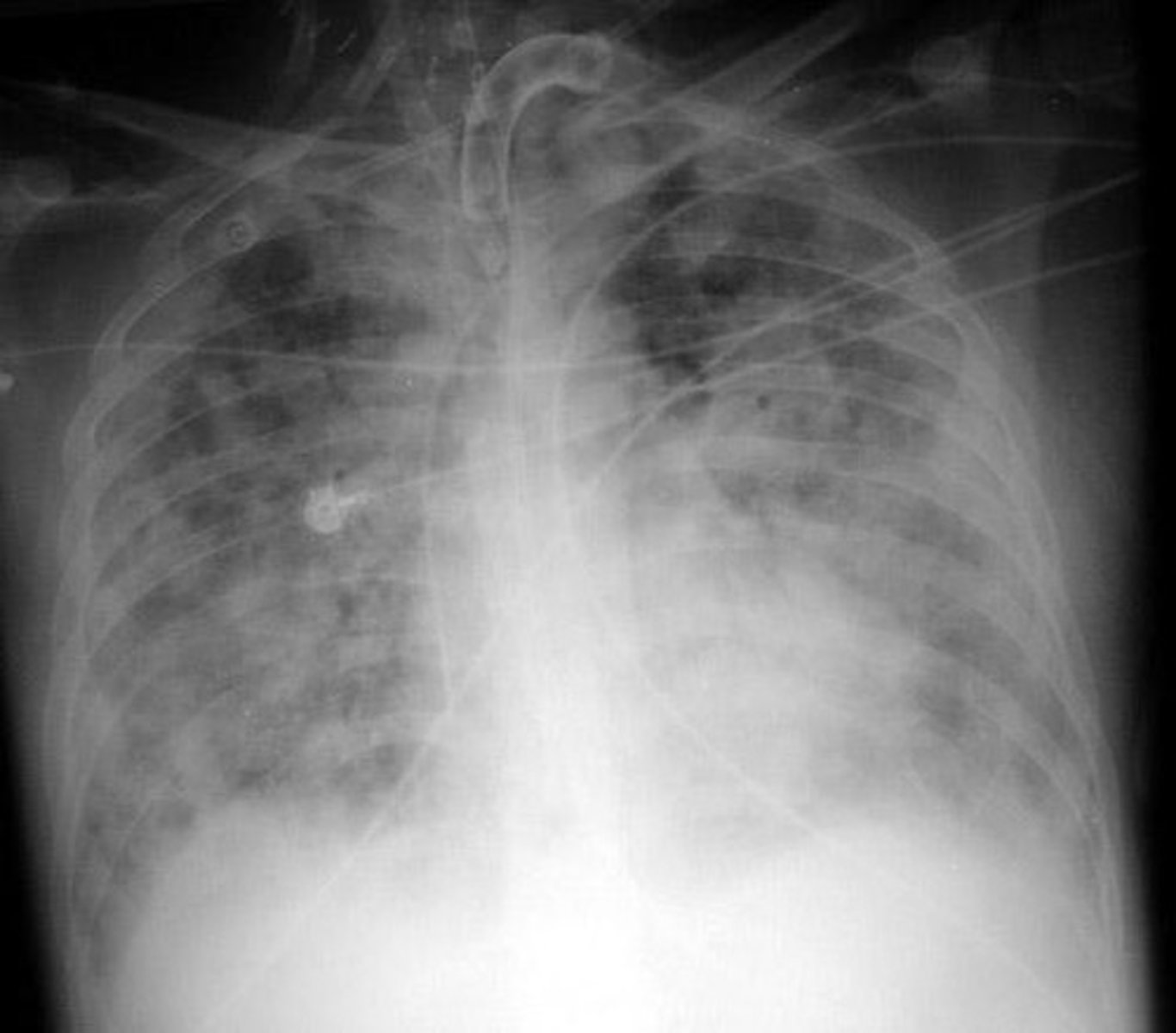 <p>Condition where one lung would be whited out with fluid</p>