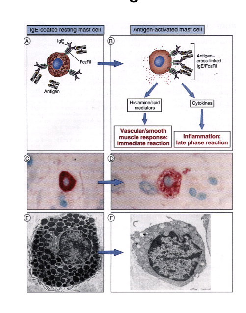 <ol><li><p>IgE-coated resting mass cell</p></li><li><p>antigen activated mast cell </p><ol><li><p>→ histamine/lipid mediators released → vascular/smooth muscle response: immediate rxn</p></li><li><p>→ cytokines released → inflammation: late phase rxn</p></li></ol></li></ol><ul><li><p>atropy = sustained, inappropriate IGE responses to common environmental antigens encountered at mucosal surfaces, usually familial association (strong hereditary component)</p></li></ul><p></p>