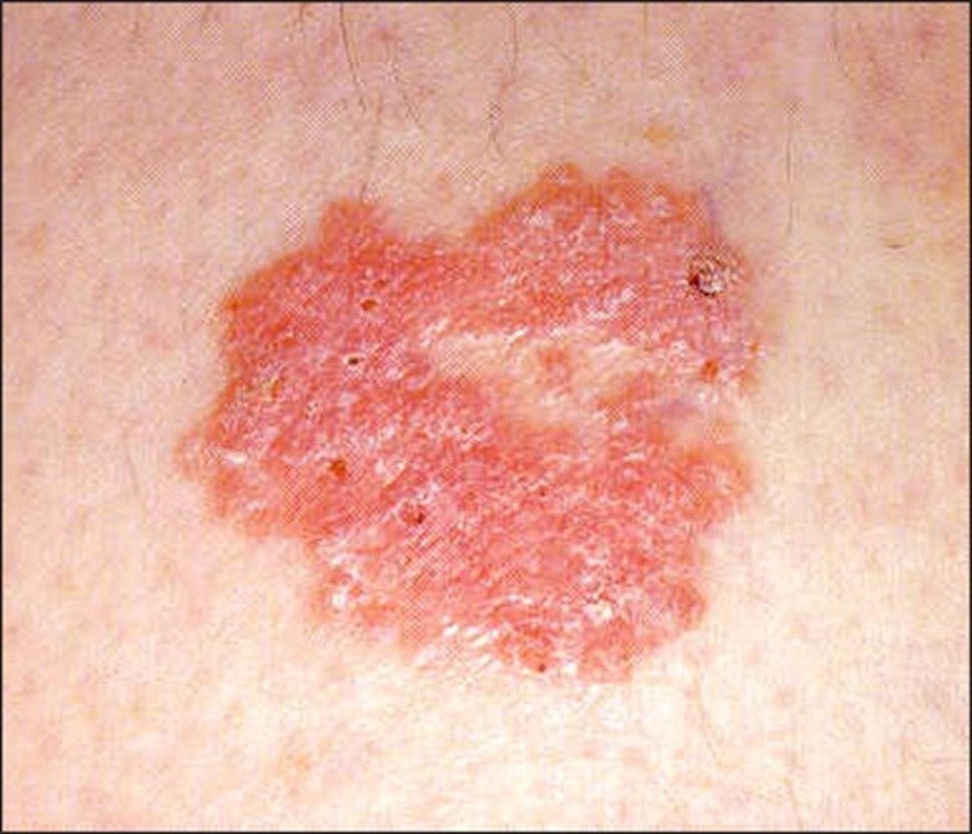 <p>Bowen's disease </p><p>Pink to red lesions, slightly scaling surface, small erosions, may be crusted</p><p>Asymptomatic but may bleed</p><p>Nodule formation indicates further invasion</p><p>Surgical excision </p>