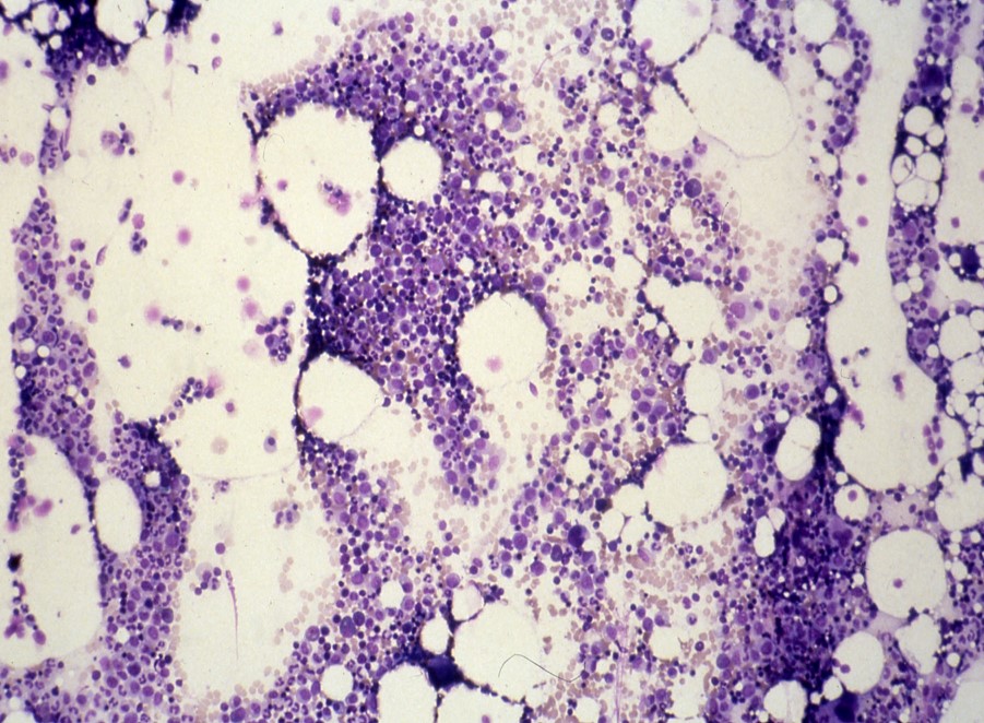 What is the Normal Cellularity of Bone Marrow?
