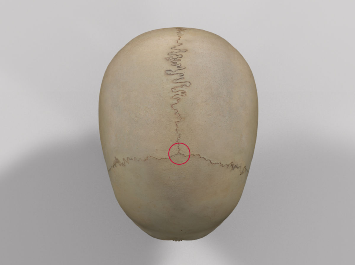 <p>Kvarstoden av fonticulus anterior</p>