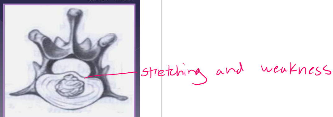 <ul><li><p>slow, progressive ataxia (weakness) </p><ul><li><p>weeks to months </p></li></ul></li><li><p>pain at the site of protrusion </p></li><li><p>TL »» cervical </p></li><li><p>differential diagnoses </p><ul><li><p>neoplasia </p></li><li><p>degenerative myelopathy </p></li><li><p>infection/inflammation </p></li><li><p>orthopedic disease </p></li></ul></li><li><p>diagnosis </p><ul><li><p>radiographs </p><ul><li><p>rule out other differentials </p></li></ul></li><li><p>MRI </p></li></ul></li></ul><p></p>