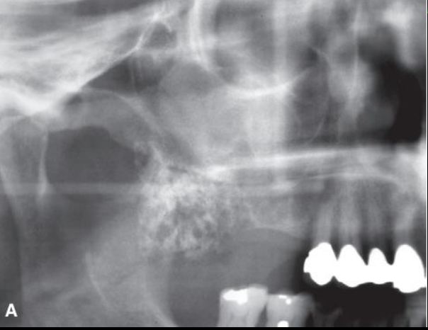 <p>Ameloblastoma</p>