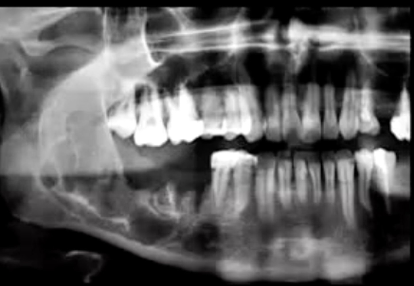 <p>multilocular radiolucent lesion</p><p>"soap bubble" or "honey combed"</p>