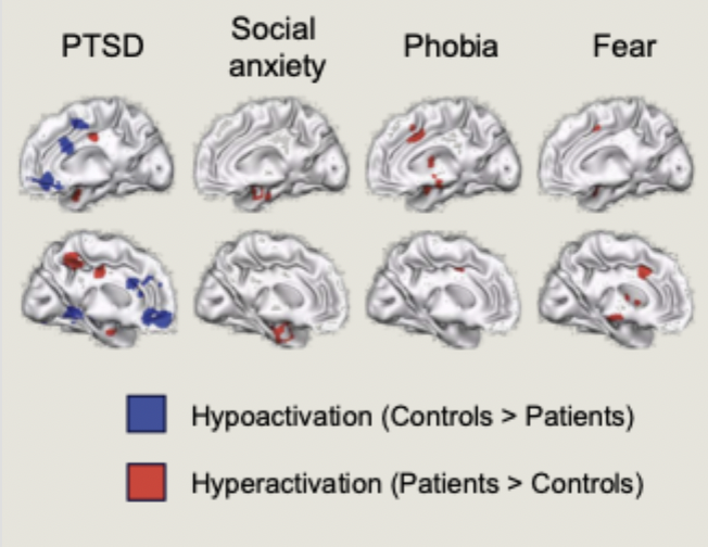 <ul><li><p>patients with any of the three disorders showed greater activity than matched comparison subjects in the amygdala and the insula</p></li><li><p>PTSD specifically showed hypoactivity in the prefrontal cortex, thalamus and the cingulate</p></li></ul><p></p>