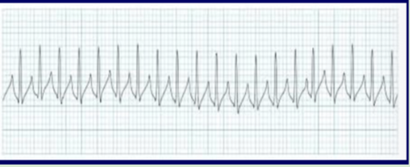 <p>Originate: atrial or AV nodal focus</p><p>QRS complex: narrow</p><p>P wave: may not be identifiable</p><p>Heart rate: 140-280 bpm</p><p>R-R intervals: regular</p>