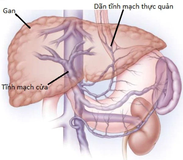 <p>giãn tĩnh mạch thực quản</p>