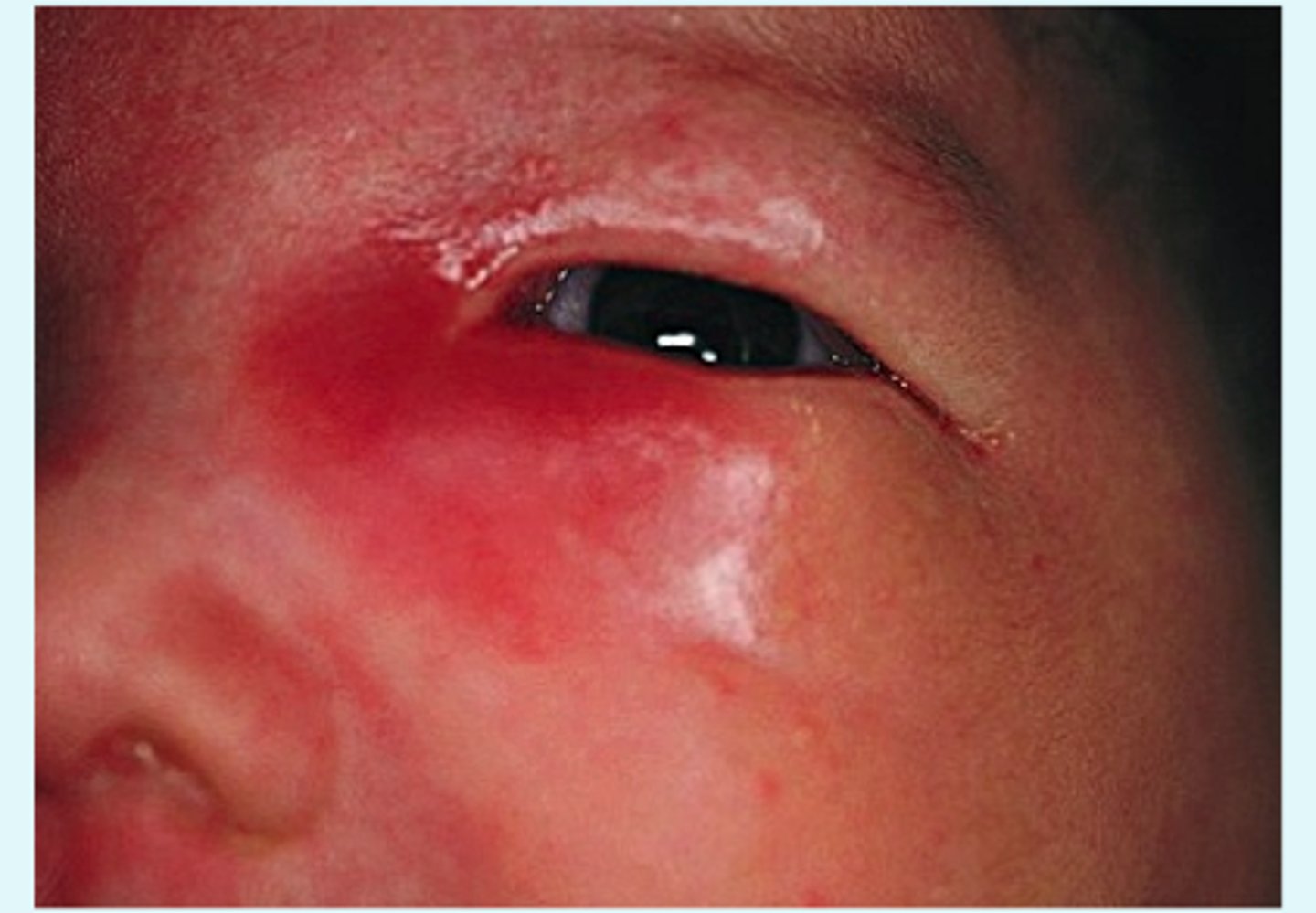 <p>Dacryocystitis</p>