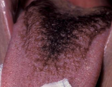 <p>What is the clinical presentation of hairy tongue?</p>
