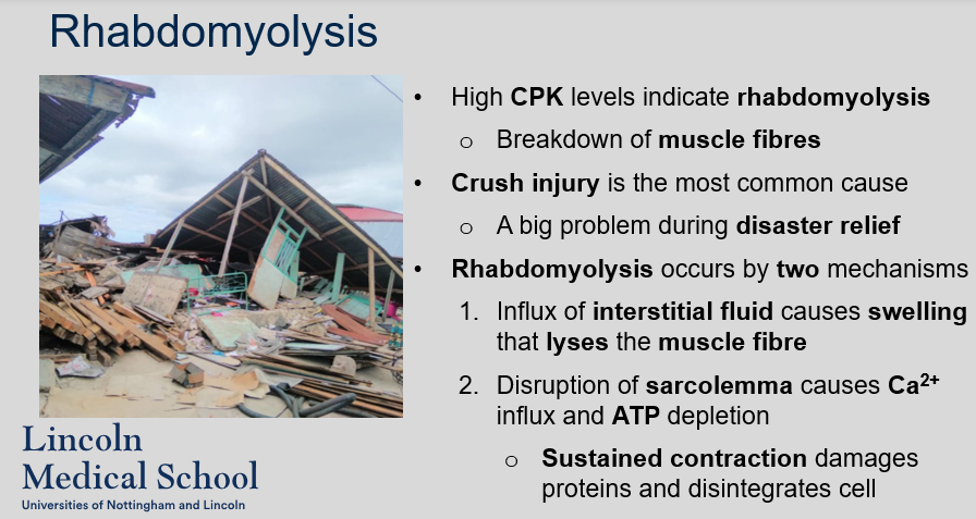 <p>High levels of CPK indicate significant muscle damage (Rhabdomyolysis). Rhabdomyolysis is the breakdown of muscle fibers, and it is the most common cause of high CPK levels. Crush injuries are a frequent cause of rhabdomyolysis. Rhabdomyolysis can occur by two mechanisms: (1) the influx of interstitial fluid causes swelling that lyses the muscle fiber, and (2) disruption of the sarcolemma causes Ca2+ influx and ATP depletion, leading to sustained contraction, damage to proteins, and disintegration of the cell.</p>