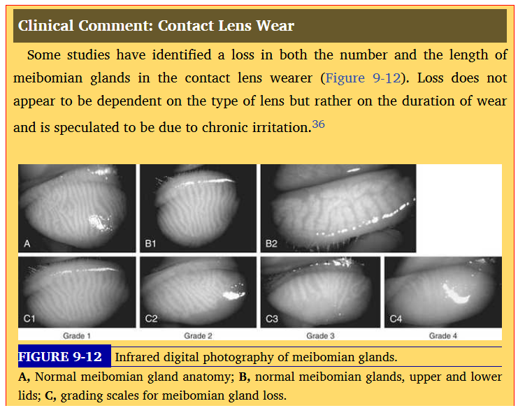 <p>loss of number of meibomian glands in cls </p><p></p>