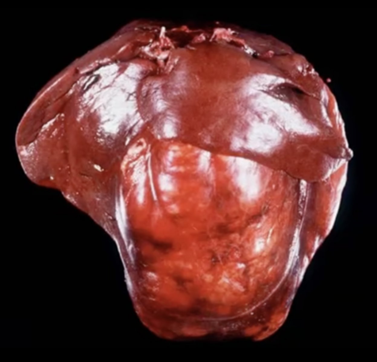 <p>What has caused this gross appearance of this liver?</p>
