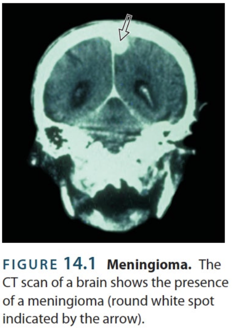<p>→ type of <strong>benign brain tumor</strong> made from cells that constitute the meninges (dura mater, arachnoid membrane, pia mater)</p><ul><li><p>Often develops right between the two cerebral hemispheres</p></li></ul><p></p>