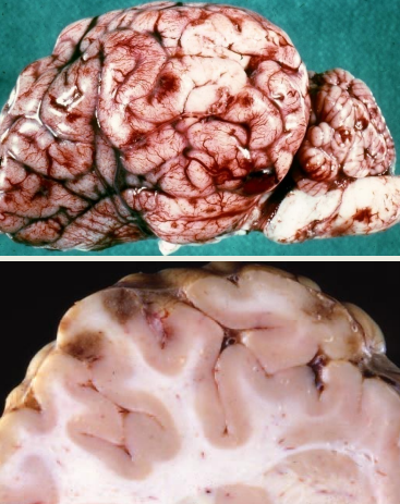 <p>• Fibrinopurulent meningitis</p><p>• Red/brown foci of haemorrhage &amp; necrosis</p><p>(infarcts) throughout brain &amp; spinal cord → virtually</p><p>pathognomonic</p>