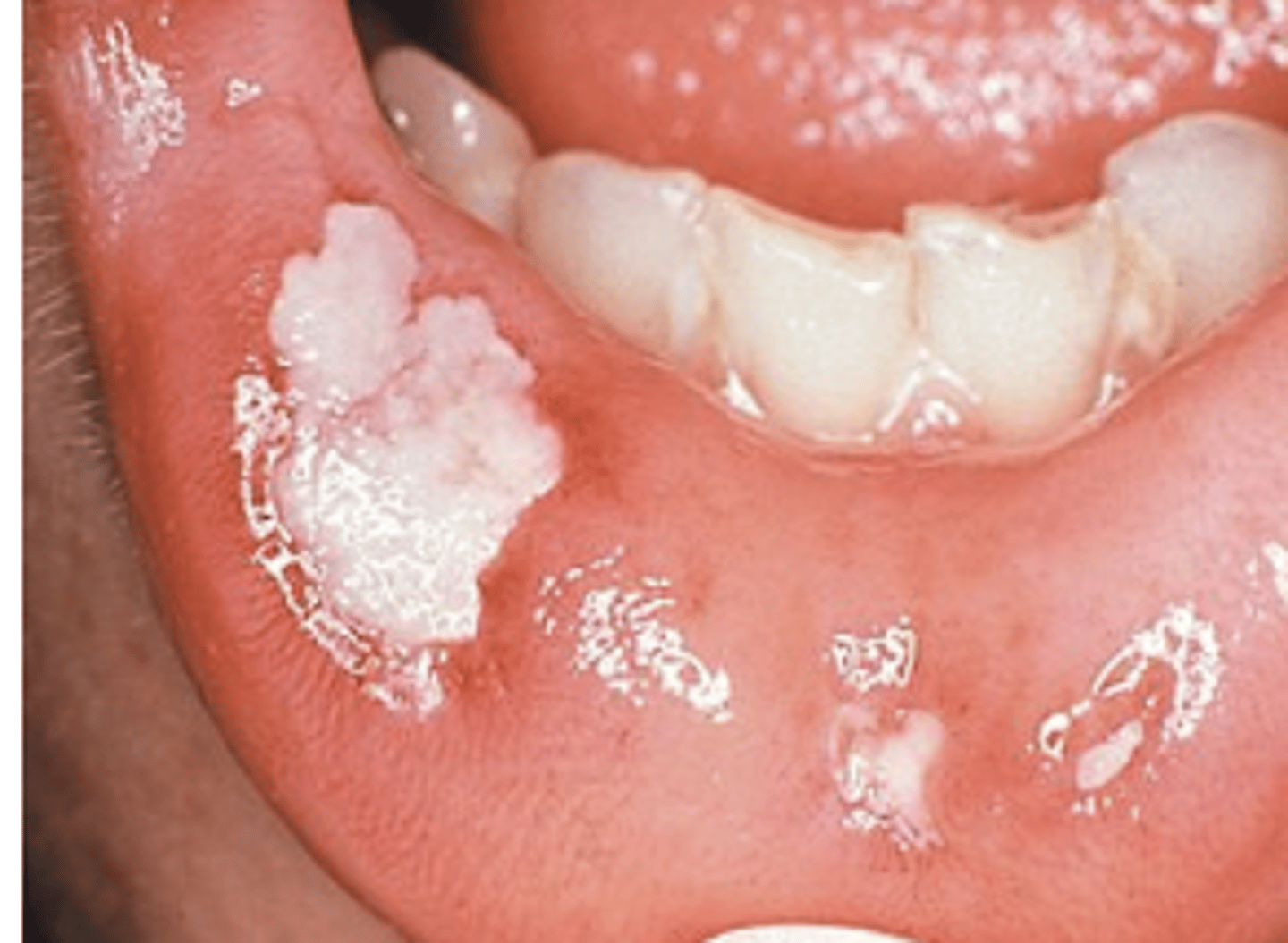 <p>Erythema</p><p>ulcers</p><p>patient CAN swallow solid food</p>