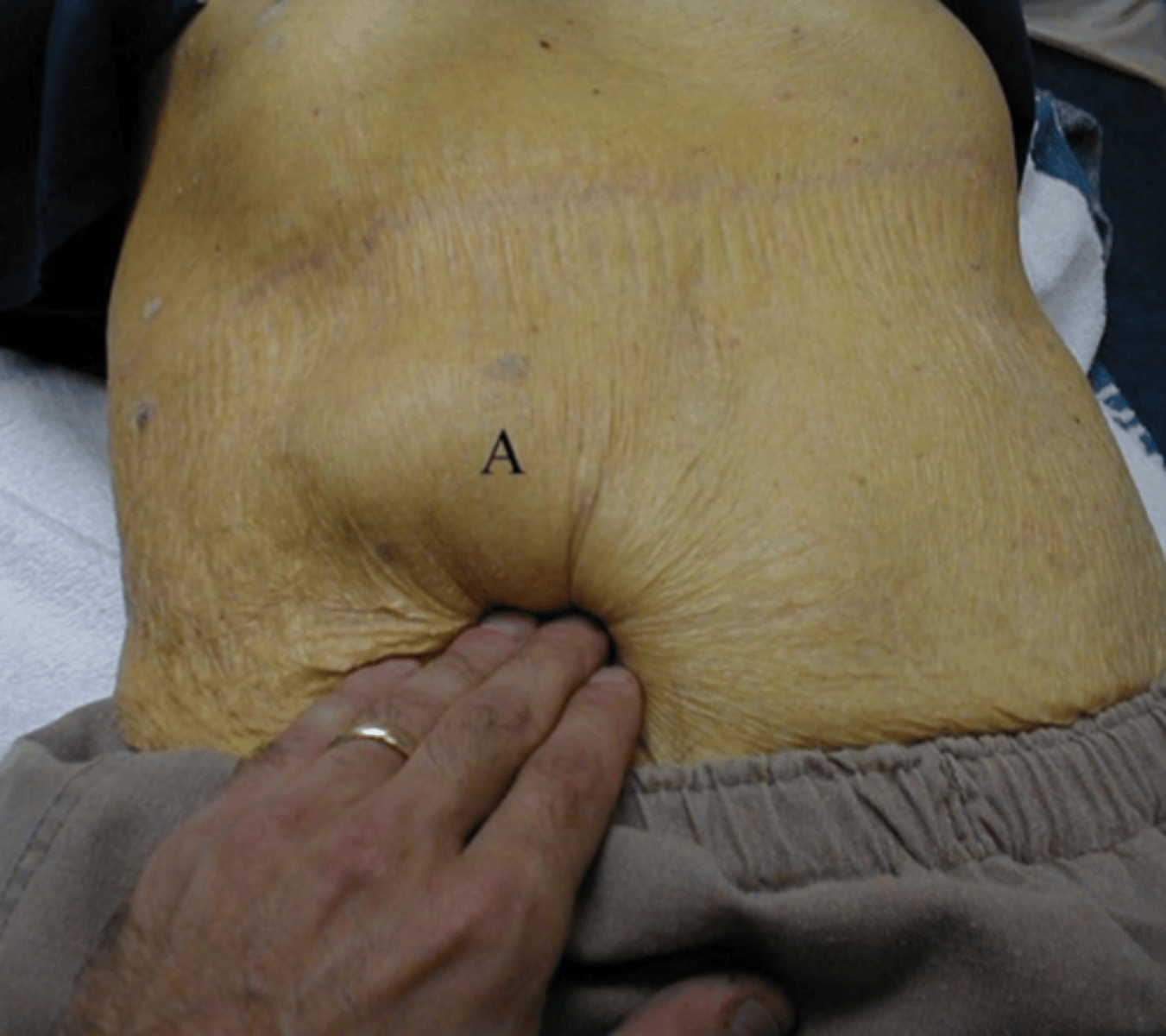 <p>Palpable, enlarged, and painless gall bladder in a patient with jaundice.</p><p>Found in those with pancreatic cancer.</p>