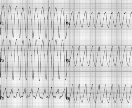 <p>What type of VT is this</p>