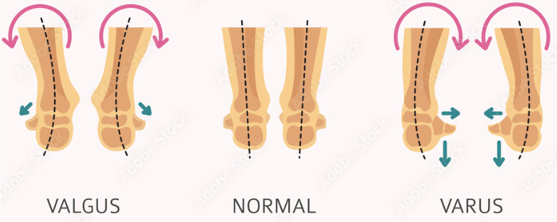 <p>Lameness, synovial effusion, limb rotation (valgus/varus)</p><ul><li><p>Short radius: Varus Leg: rotated outwards </p></li><li><p>Short ulna: Valgus Leg: rotation inwards (most common) → Causes radius to bend as it continues to grow </p></li></ul><p></p>