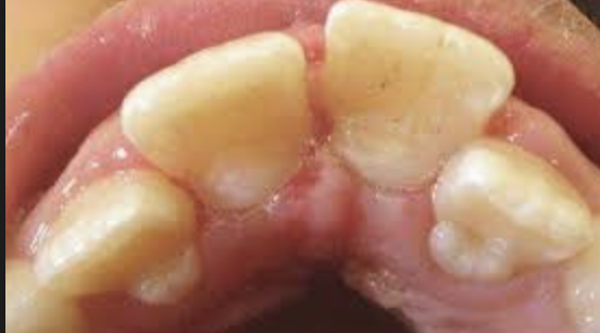 <p>incisal portion of cingulum may exhibit tubercle (accessory cusp)  </p>