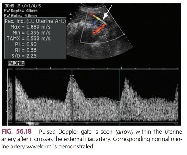 <ul><li><p>The uterine arteries are the <strong>main blood supply to the placenta</strong>.</p></li><li><p>By assessing them with color Doppler, we can see if <strong>enough oxygen and nutrients</strong> are reaching the placenta and fetus.</p></li><li><p>It helps detect problems like <strong>placental insufficiency</strong> (when the placenta isn’t getting enough blood), which can lead to <strong>fetal growth restriction</strong> or <strong>preeclampsia</strong>.</p></li><li><p>In a healthy pregnancy, the __________ shows _____ (good continuous flow throughout diastole), meaning the placenta is <strong>well perfused and active</strong>.</p></li><li><p>If there’s <strong>high resistance</strong> or <strong>notching</strong> in the waveform, it can suggest <strong>poor placental development or function</strong>.</p></li></ul><p></p>