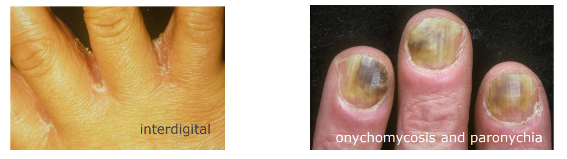 <p>predisposing factors for Fingerweb / finger nail  candidiasis</p>