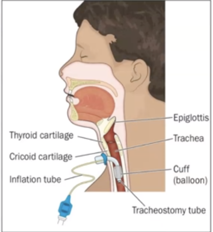 <p>incision made below the cricoid cartilage, and a tracheal tube is inserted to create an emergency air passageway</p>