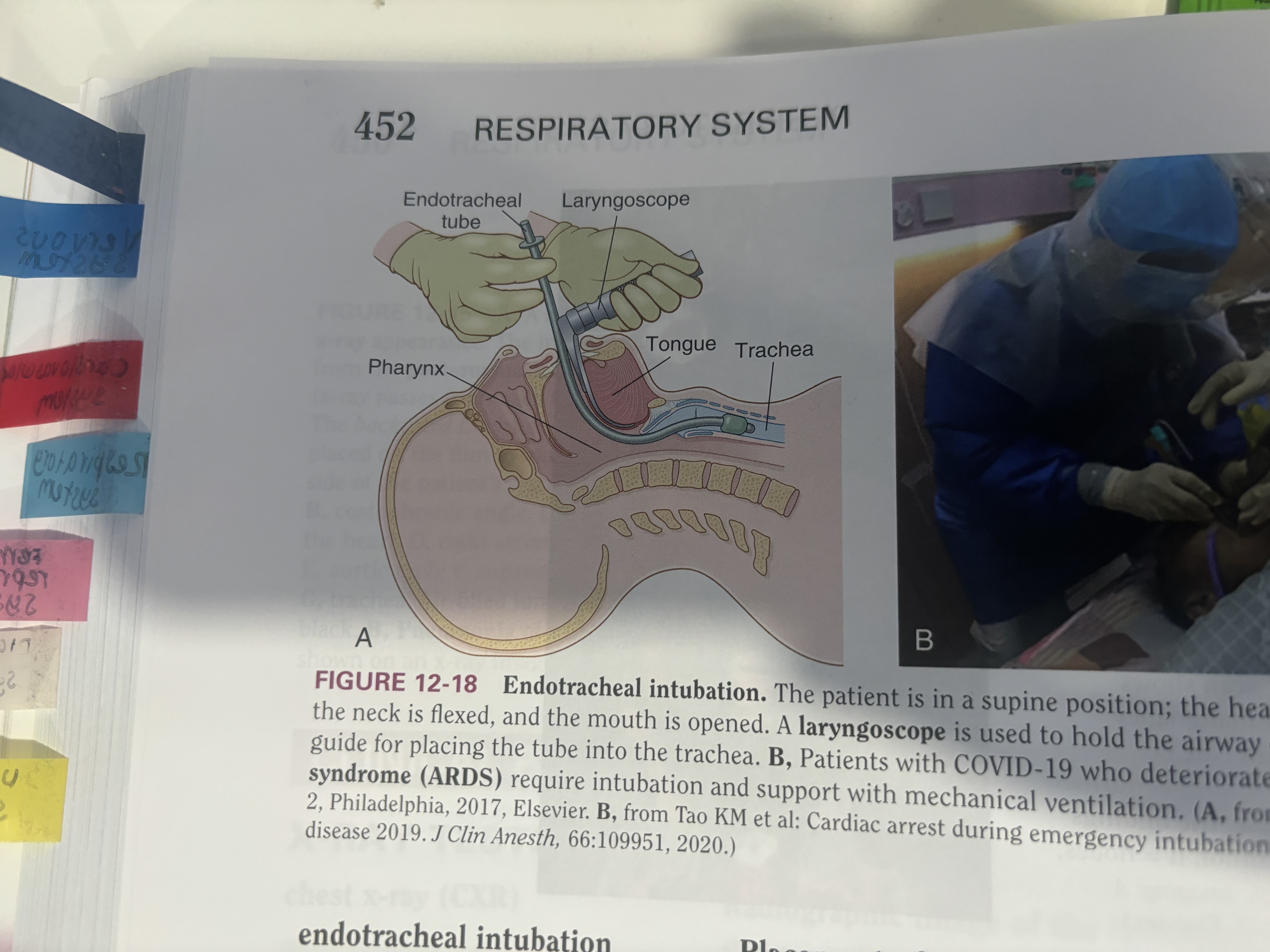 <p>placement of a tube through the mouth into pharynx, larynx and trachea to establish an airway.</p>