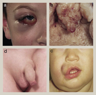 <p>Rhabdomyosarcoma </p><p></p>