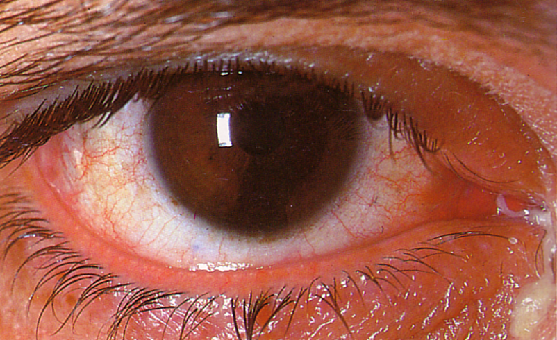 <ul><li><p><span>Inflammation of the canaliculi - relatively rare&nbsp;</span></p></li><li><p><span>Px over 50s&nbsp;</span></p></li><li><p><span>Signs include - <strong>chronic unilateral red eye with epiphora - mucopurulent discharge, more likely to be inferiorly&nbsp;</strong></span></p></li></ul><p><span>Can get <strong>dacryoliths </strong>building up - form pockets and block drainage</span></p>
