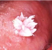 <p>latin for "common wart"</p><p>a <span style="color: rgb(255, 0, 0);">benign epithelial lesion </span>of the skin and mucous membrane</p><ul><li><p><strong>cause:</strong></p><ul><li><p><span style="color: red;">human papillomavirus (HPV) types 1, 2, 4</span></p></li></ul></li></ul><ul><li><p><strong>management:</strong></p><ul><li><p>similar to that for a fibroma</p></li><li><p>excisional biopsy</p></li></ul></li></ul><p></p>