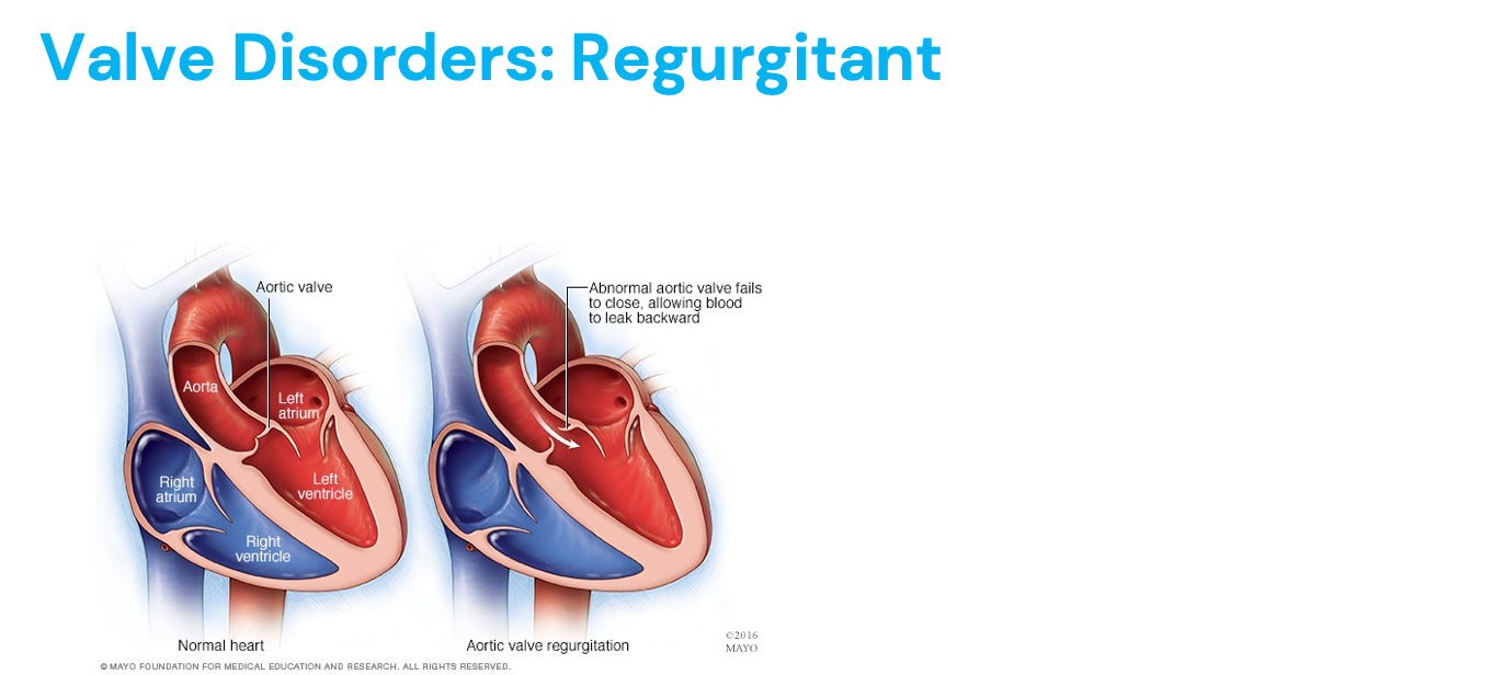 <ul><li><p>“Closing disorder”</p></li><li><p>Can be caused by:</p><ul><li><p>Mitral valve prolapse</p></li><li><p>Damaged tissue cords</p></li><li><p>Rheumatic fever</p></li><li><p>Endocarditis </p></li><li><p>Heart attack </p></li><li><p>Abnormality of the heart muscle (cardiomyopathy) </p></li><li><p>Trauma </p></li><li><p>Congenital heart defects</p></li></ul></li><li><p><mark data-color="yellow" style="background-color: yellow; color: inherit;">Where does the blood back into? What would these patients present with?</mark></p><ul><li><p>AR = LV preload/EDV? LV ESV?</p></li><li><p>MR = retrograde flow from LV to LA during systole, LV preload? (increased( </p></li><li><p>Increased EDV!</p></li></ul></li><li><p>Endocarditis = vegetations </p></li></ul><p></p>