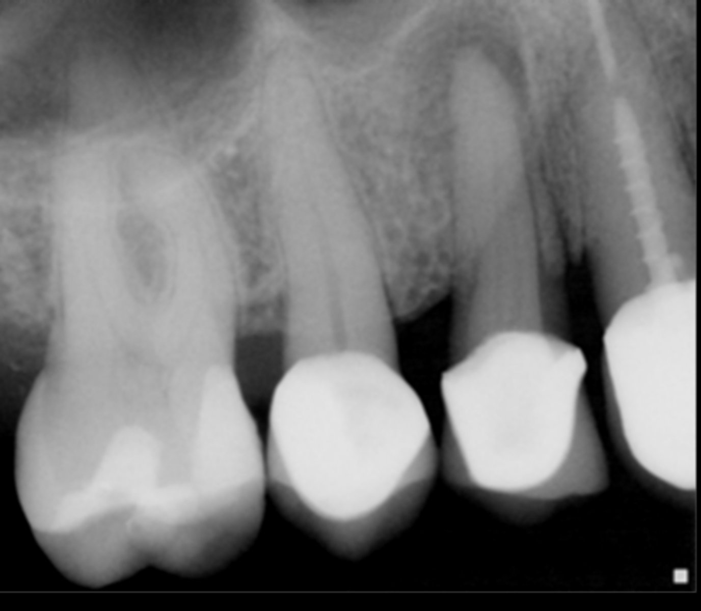 <p>Which restorative material is not seen below?</p><p>a. PFM crown</p><p>b. Gutta-percha</p><p>c. Amalgam</p><p>d. Composite resin</p><p>e. Post</p>