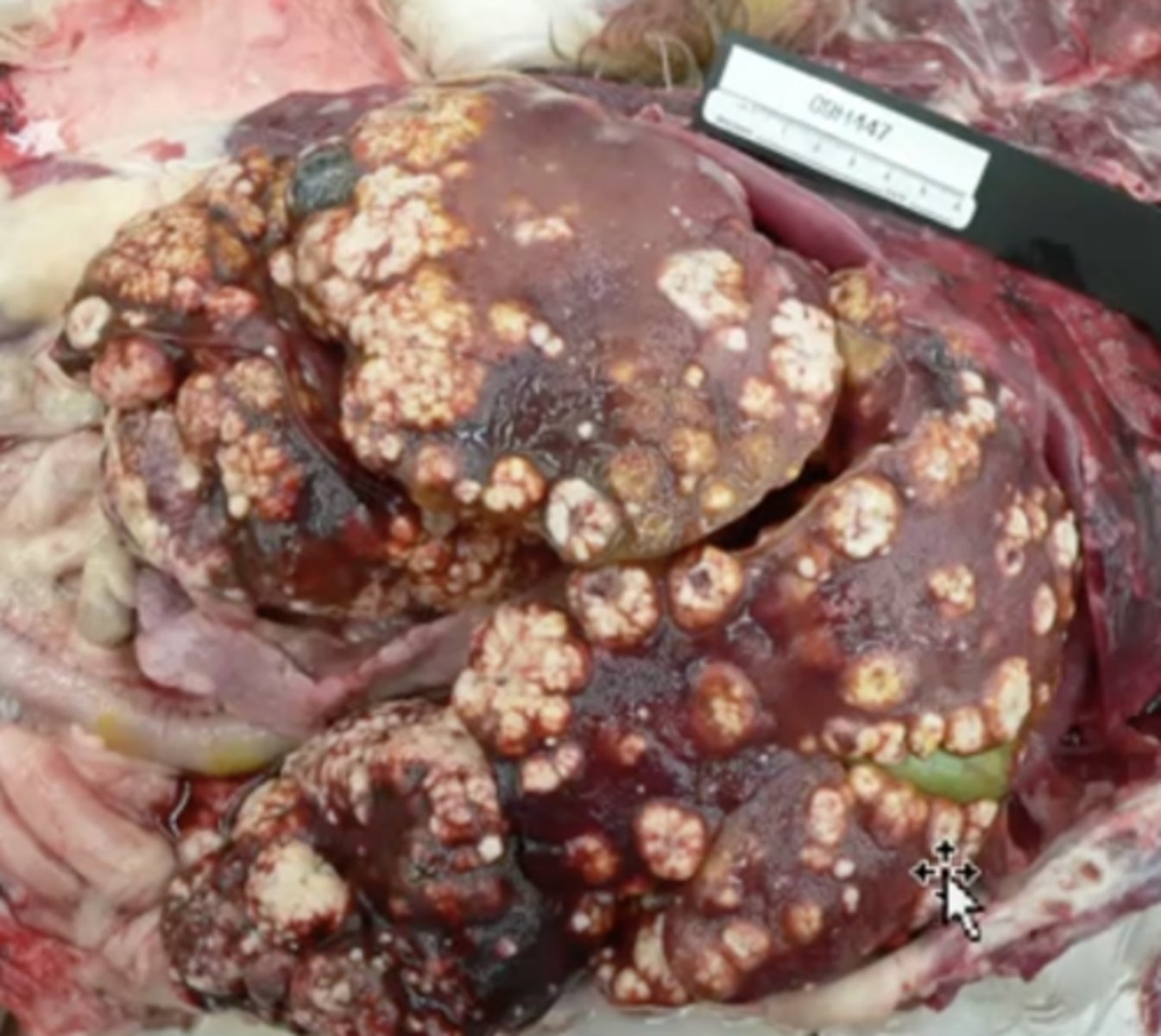 <p>What has caused this gross appearance of this liver?</p>