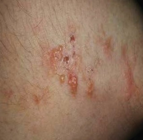 <ul><li><p>Dermatitis herpetiformis (itchy blister rash affecting knees, elbows and natal cleft)</p></li></ul><ul><li><p><strong><em>Failure to thrive</em></strong> in young children</p></li><li><p>Diarrhoea</p></li><li><p>Bloating</p></li><li><p>Fatigue</p></li><li><p>Weight loss</p></li><li><p>Mouth ulcers</p></li></ul><p>&nbsp;</p><p></p>