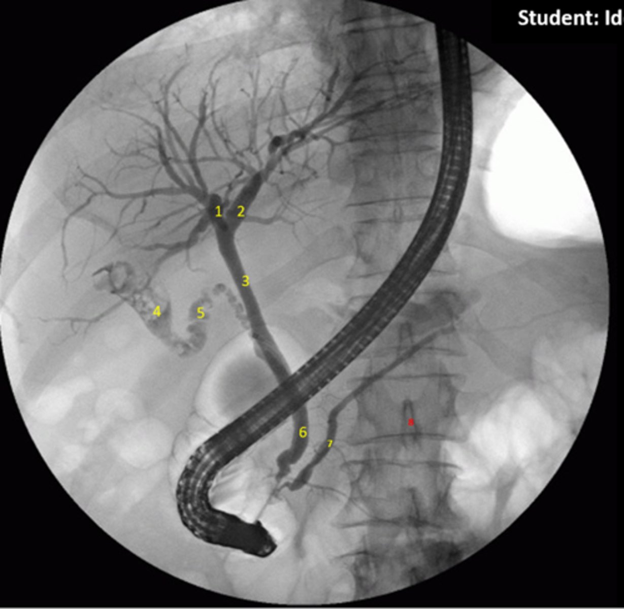 <p>1.Right hepatic duct</p><p>2.Left hepatic duct</p><p>3.Common hepatic duct</p><p>4.Gallbladder</p><p>5.Cystic duct</p><p>6.Common bile duct</p><p>7.Pancreatic duct</p><p>8.Spinous process</p>