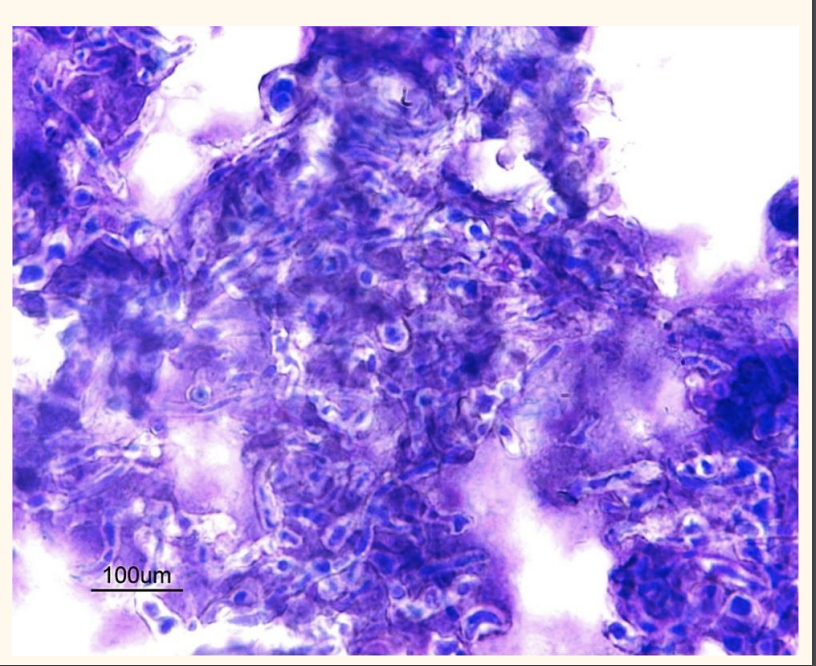 <p>What can you see on this aspirate?</p>