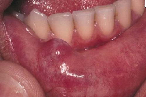 <p>What is the treatment for a mucocele?</p>