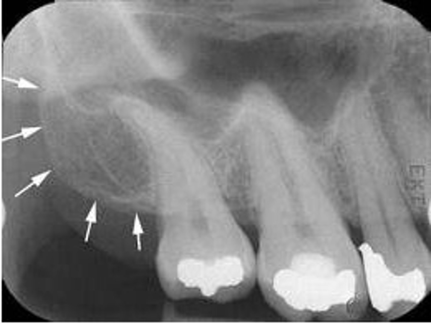 <p>rounded portion of bone behind the last tooth</p><p>radiopaque</p>
