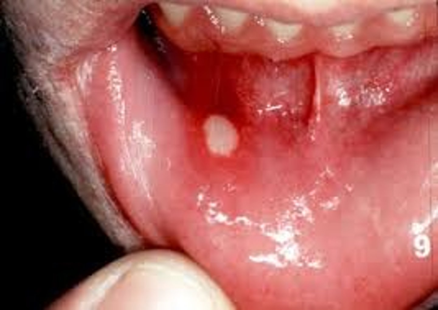 <p>EPIDEMIOLOGY</p><p>- very common in pt with chemo or radiation</p><p>- age, nutrition, and oral hygiene play a role</p><p>PATHO</p><p>- inflammation and ulcers of the lining of the mouth</p><p>- most common on tongue and buccal area</p><p>RISK FACTORS</p><p>- radiation, chemotherapy, and oral hygiene</p><p>- viral, bacterial, fungal infections</p><p>- irritants like alcohol, tobacco, and mouth wash</p><p>-vitamin deficiencies like V b, folate, zinc, and iron</p><p>- Systemic diseases:chronic kidney and inflammatory bowel</p><p>COMPLICATIONS</p><p>- pain</p><p>-dysphagia(trouble swallow) and odynophagia (painful swallow) causing aspiration risk</p><p>- inflammation/open lesions that cause cause airway obstructions and infections</p><p>MEDICAL MANAGEMENT</p><p>- assess oral cavity throughout chemo or radiation</p><p>- dental cleaning a month before</p><p>- oral rinse (saline or sodium bicarb) every 4 hours</p><p>- room humidification</p><p>- topical analgesics and moisturizers</p><p>ASSESSMENT</p><p>- determine offending irritant like chemo, radiation, and steroids that can decrease immune function</p><p>- assess pt for opportunistic infections due to impaired immune function and inadequate nutrition</p><p>- vital signs: weight loss, dehydration (low BP and high HR), elevated temp if infection present</p><p>- nutritional intake most likely dehydrated and poor</p><p>- intake and output most likely low</p><p>NURSING ACTIONS</p><p>- aspiration precautions</p><p>- HOB 45 degrees</p><p>- suction equipment at bedside</p><p>- administer meds (antiviral like acyclovir/zovirax and antifungal like nystatin)</p><p>- viscous lidocaine to numb mouth and help with pain</p><p>- administer water-soluble lubricants for lips and mouth</p><p>TEACHING</p><p>- Mouth care after meals with soft bristle toothbrush</p><p>- Discourage use of alcohol mouthwash</p><p>- Remove dentures and clean after every meal and clean them</p><p>- Encourage regular dental check ups</p><p>- Saline mouth rinse q4 hours</p><p>- Dietary choices</p>