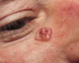 <p>COMMON DISORDERS SEEN WITH AGING</p><p>• <span style="color: red;">Most common form of skin cancer </span></p><p>• Most <mark data-color="red" style="background-color: red; color: inherit;">particularly dangerous </mark></p><p>• Appears <mark data-color="blue" style="background-color: blue; color: inherit;">similar to a red mole or sore </mark></p>