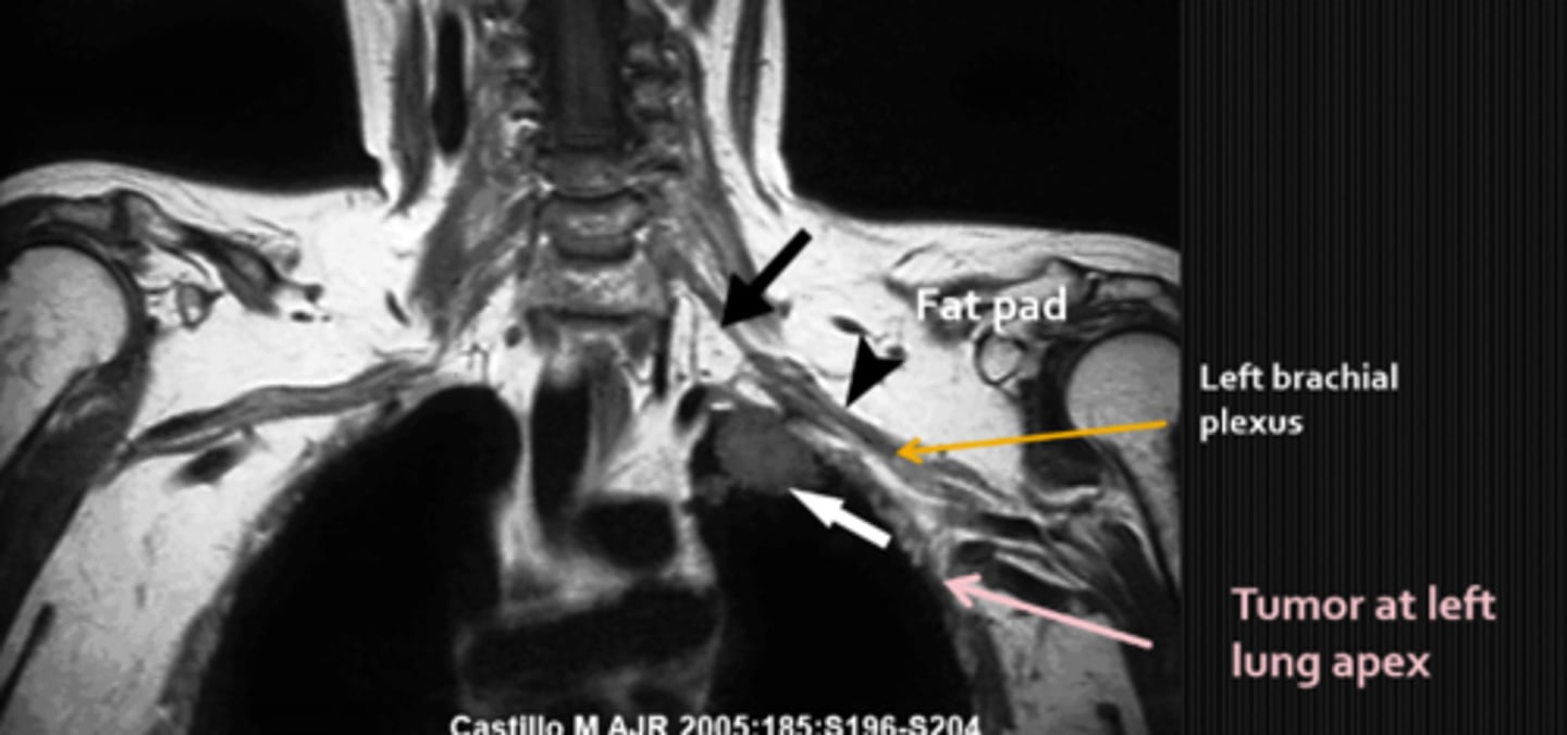 <p>Pancoast tumor that affects the symp fibers traveling over apex of lung</p>