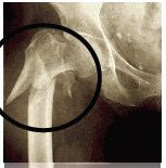 <p>Pathological fracture</p>