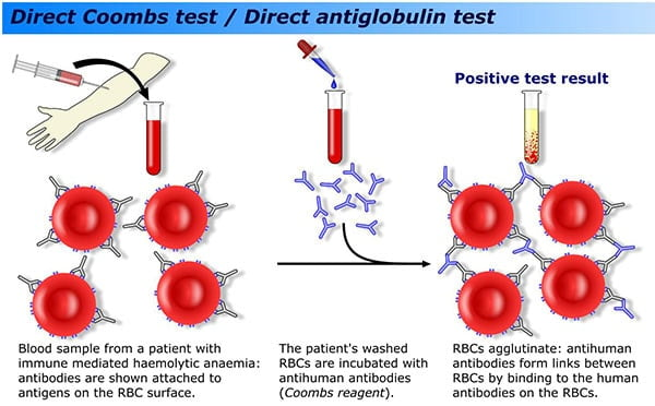 <p>A test which demonstrates the presence of antibodies or complement on circulating RBCs</p><p>Ex: Rh factor</p>