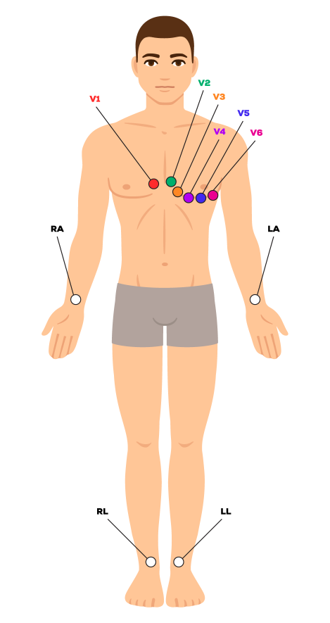 <ol><li><p>V1 - fourth intercostal space on the right sternum</p></li><li><p>V2 - fourth intercostal space at the left sternum</p></li><li><p>V3 - Midway between placement of V2 and V4</p></li><li><p>V4 - fifth intercostal space at the midclavicular line</p></li><li><p>V5 - anterior axillary line on the same horizontal level as V4</p></li><li><p>V6 - mid-axllary line on the same horizontal level as V4 and V5</p></li><li><p>RA (right arm) - anywhere between the right shoulder and the right elbow</p></li><li><p>RL (right leg) - lateral calf muscle</p></li><li><p>LA (left arm) - anywhere between the left shoulder and the left elbow</p></li><li><p>LL (left leg) - lateral calf muscle</p></li></ol><p></p>